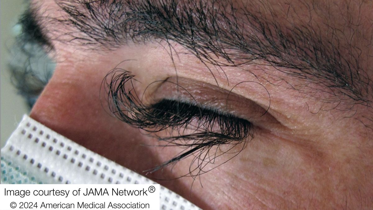 Chemo side effect caused man's eyelash growth to go haywire - Livescience.com