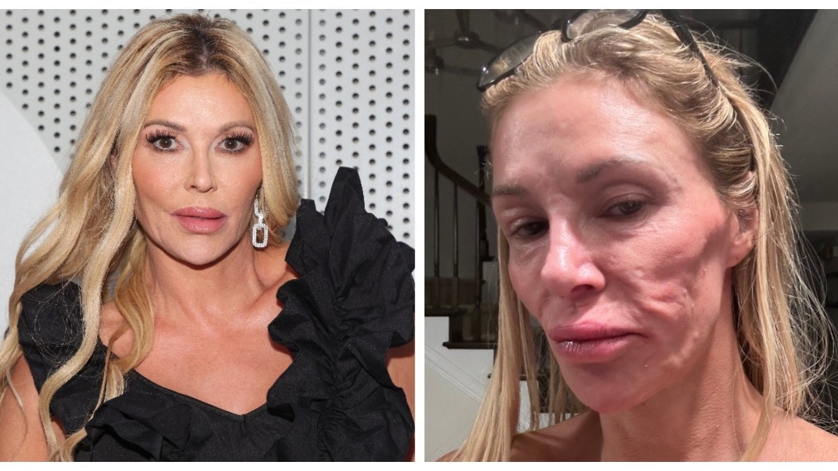 'Real Housewives' Star Brandi Glanville Says 'Parasite That Jumps Around my Face' is Responsible for Dramatic Change in Appearance - TheWrap